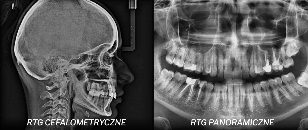 RTG panoramiczne i cefalometryczne